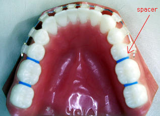 Spacers for braces